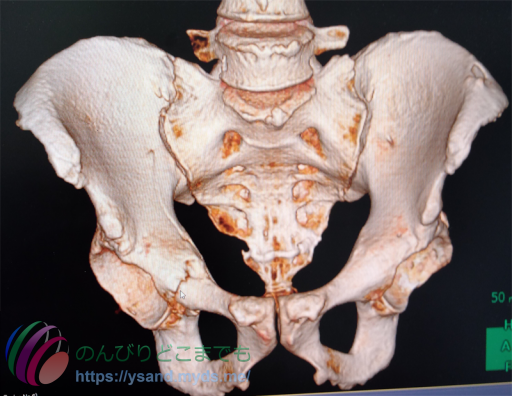 骨盤骨折時のCTスキャン結果を3D化したもの、ただしこれは高崎総合医療センターで撮らせてもらった物